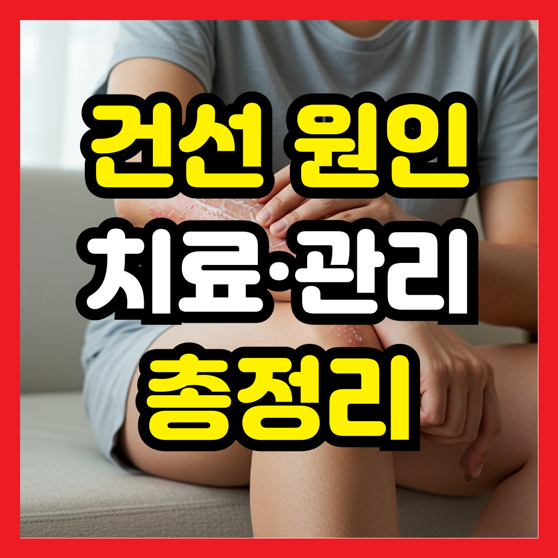 피부통증-건선-원인