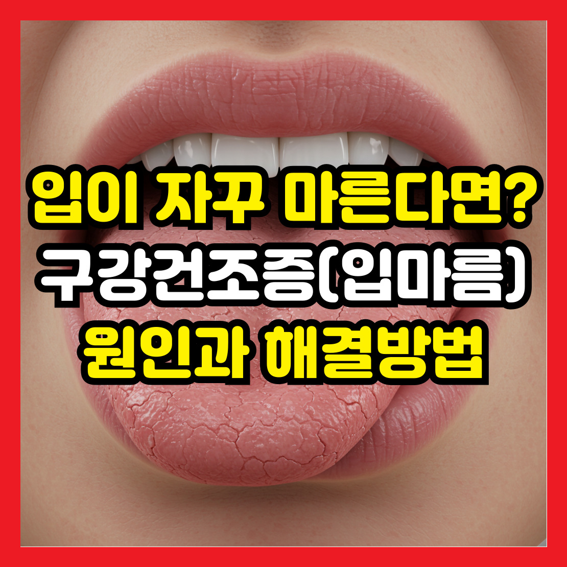 구강건조증